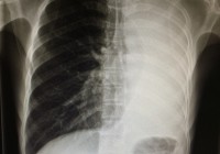 タイでCase Study　５０歳男性　主訴「咳　左の首の痛み」